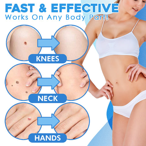 Skin Tag Removal Kit