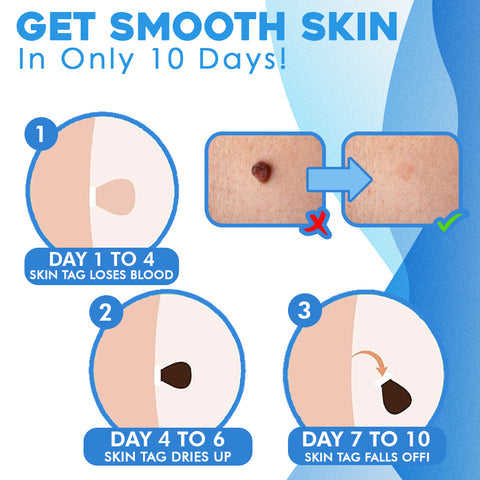 Skin Tag Removal Kit