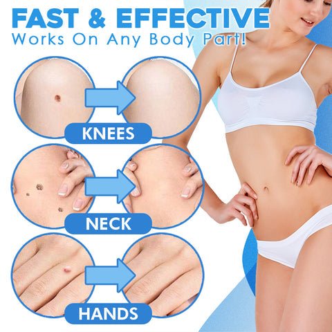 Skin Tag Removal Kit - Top quality