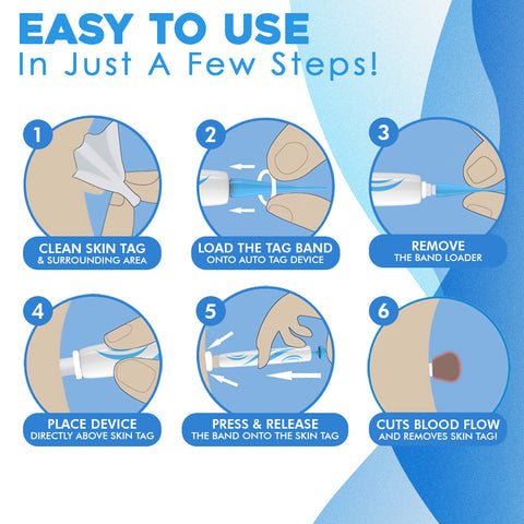 Skin Tag Removal Kit - Top quality