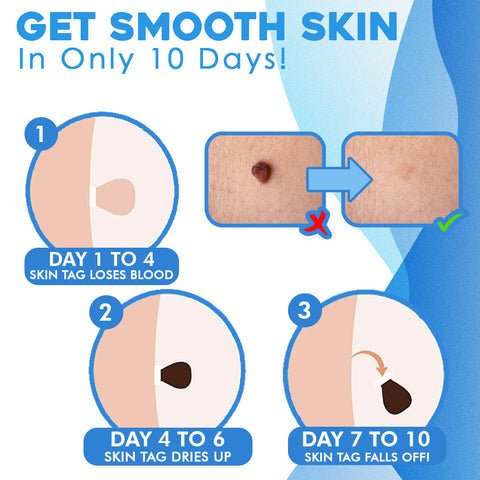Skin Tag Removal Kit - Top quality