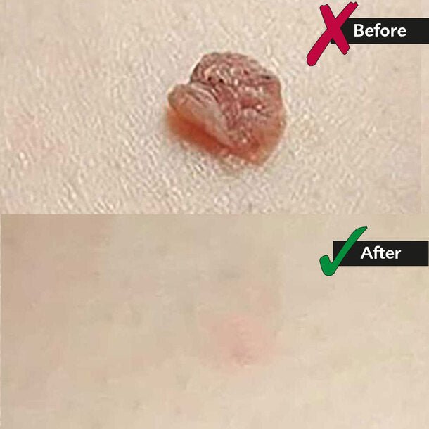 Skin Tag Removal Kit - Top quality