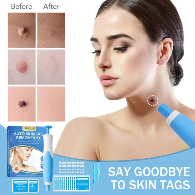 Skin Tag Removal Kit - Top quality